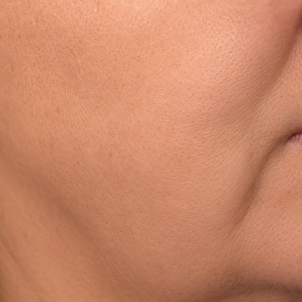 Flacidez facial