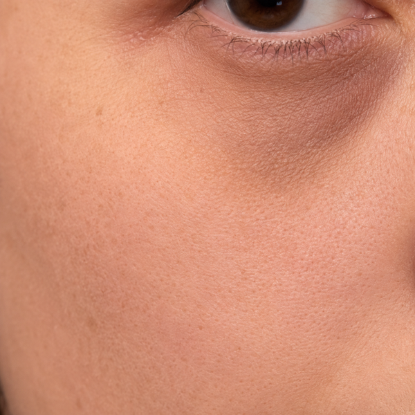 Ojeras